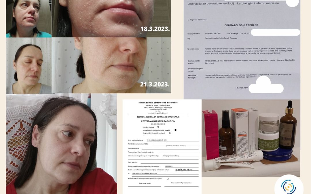 Seboreični dermatitis i rozacea – samoiscjeljenje